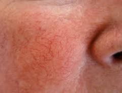 rosacea4.jpeg